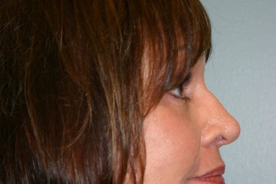 Brow Lift Before & After