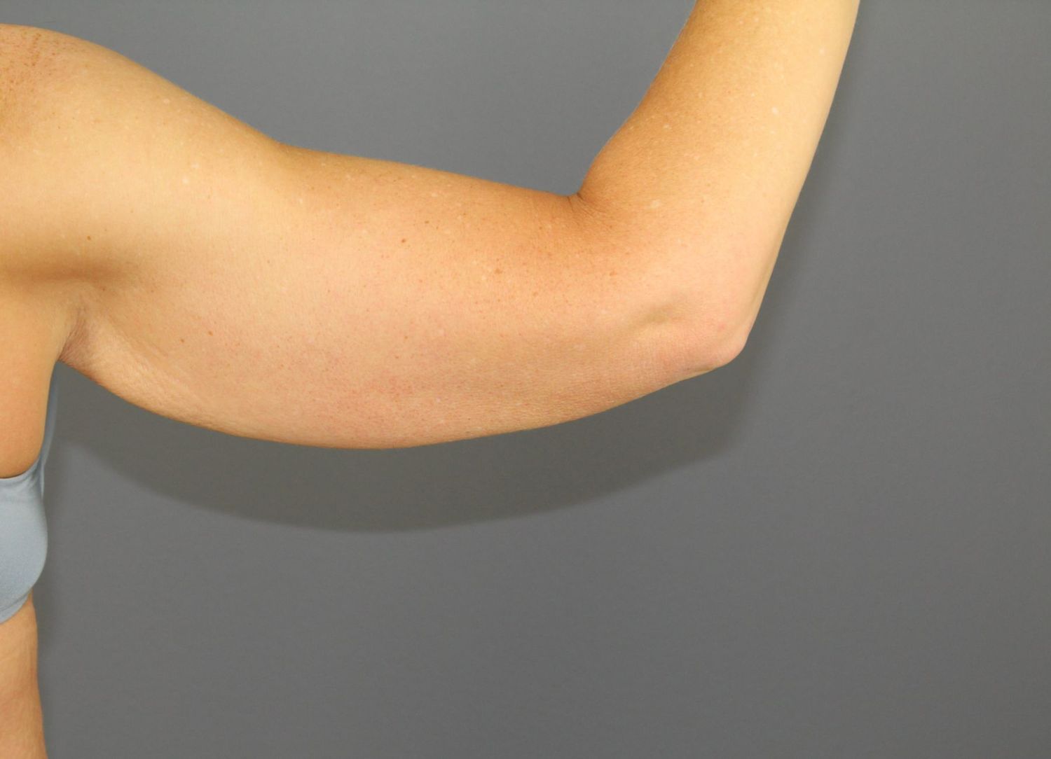 Arm Lift Before & After