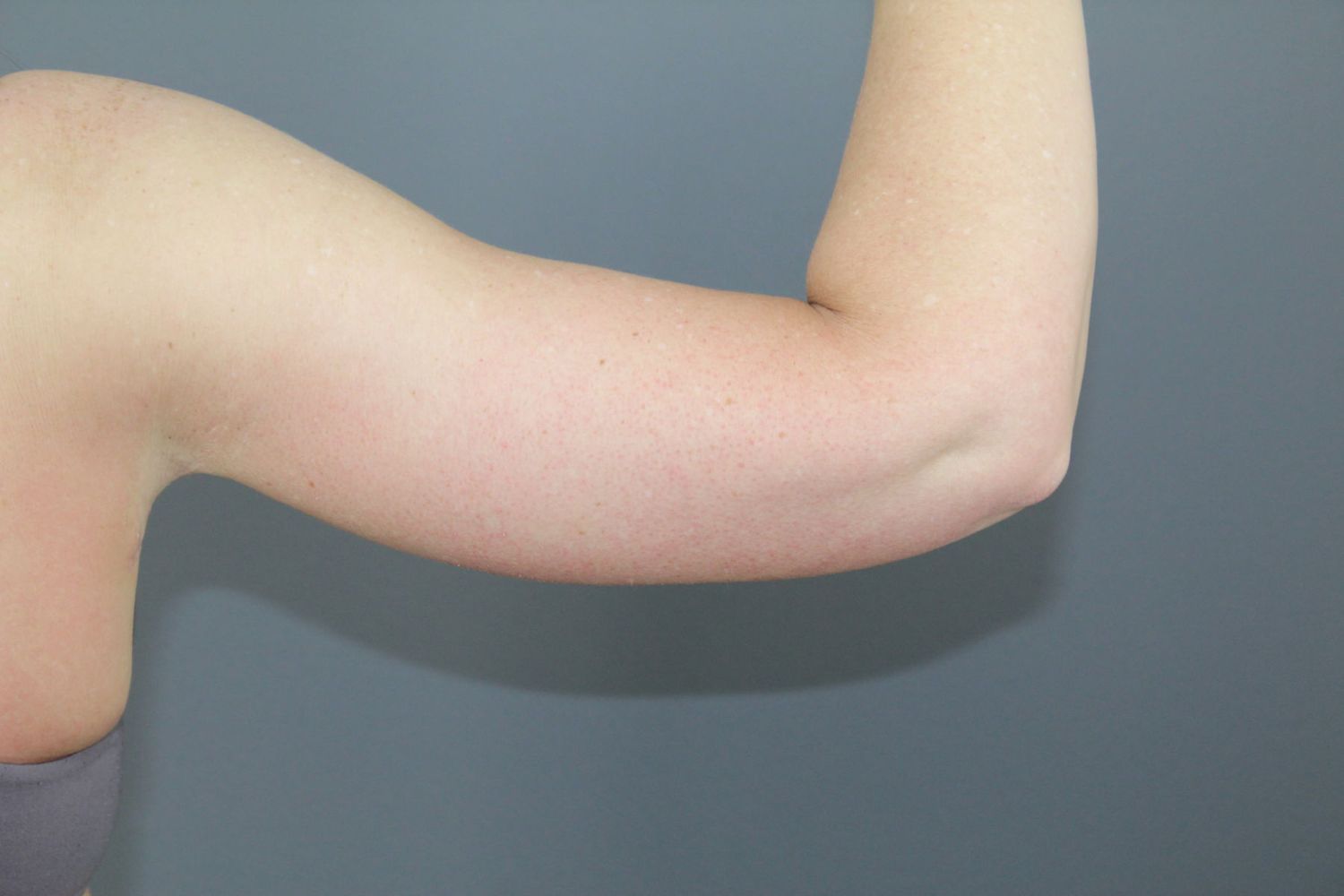 Arm Lift Before & After