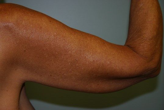 Arm Lift Before & After