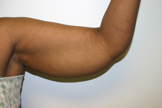 Arm Lift Before & After