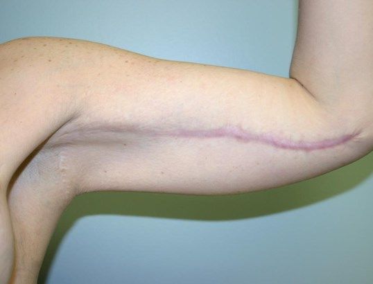 Arm Lift Before & After