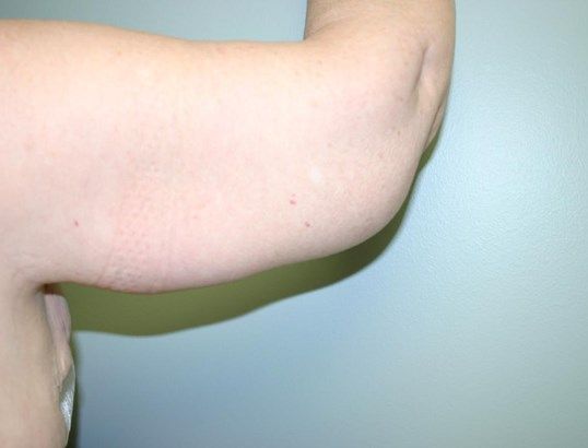 Arm Lift Before & After