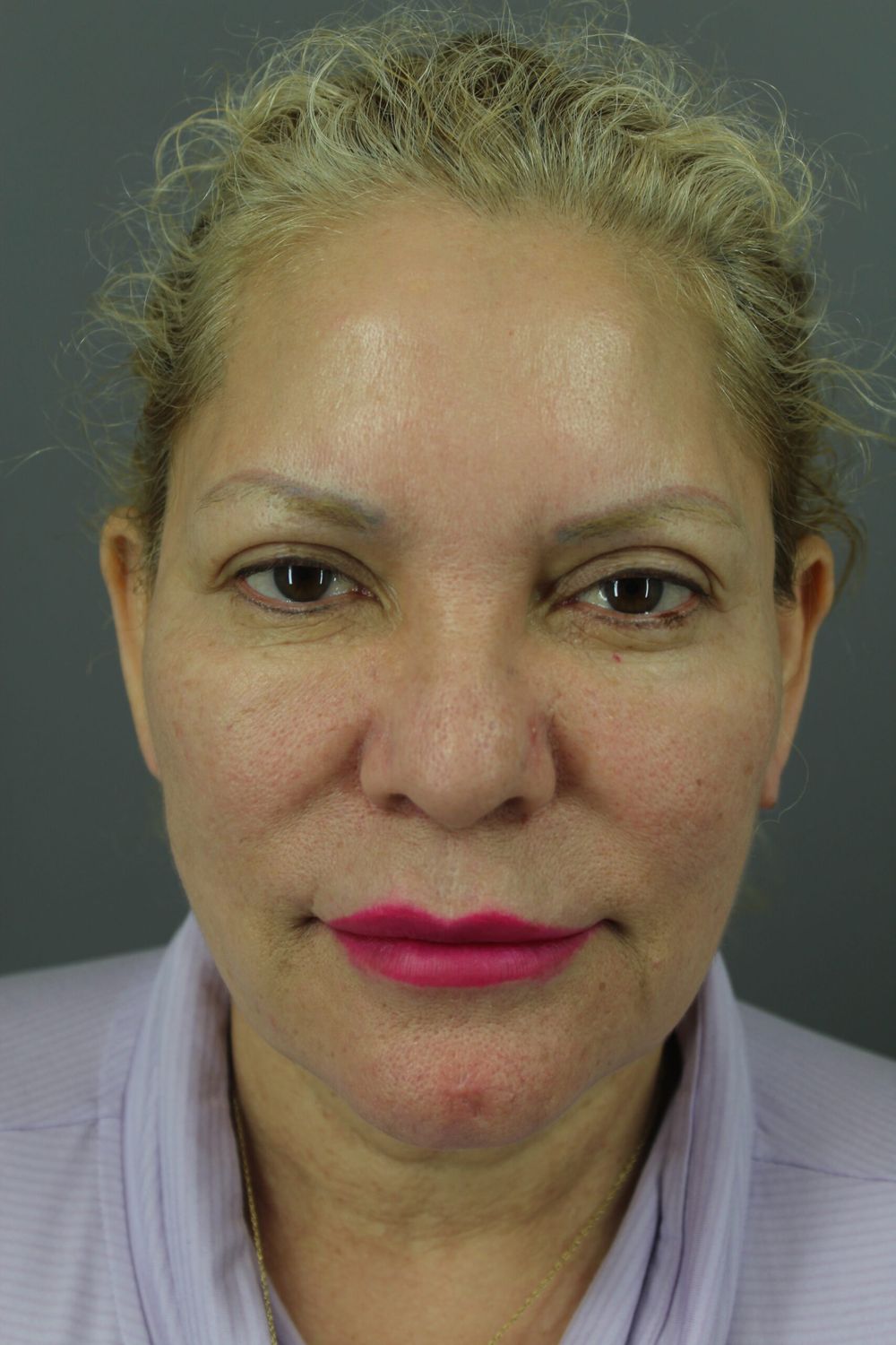 Laser Skin Resurfacing Before & After