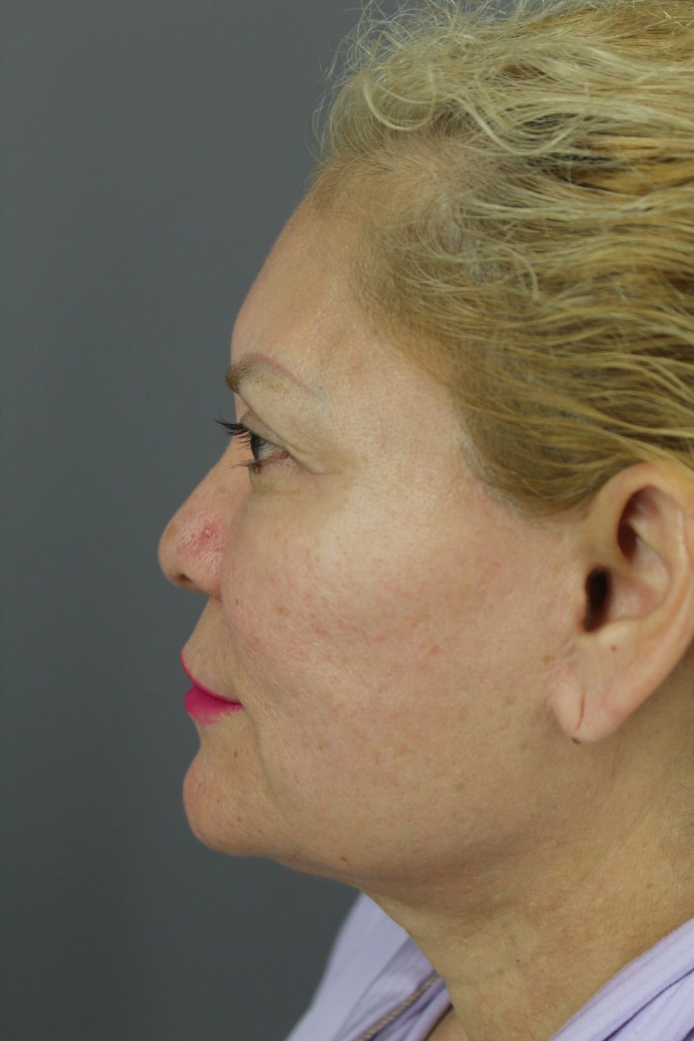 Laser Skin Resurfacing Before & After