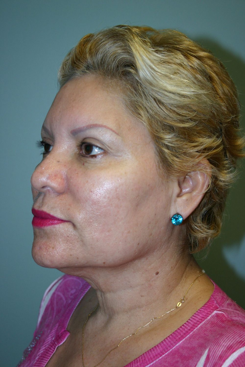 Laser Skin Resurfacing Before & After