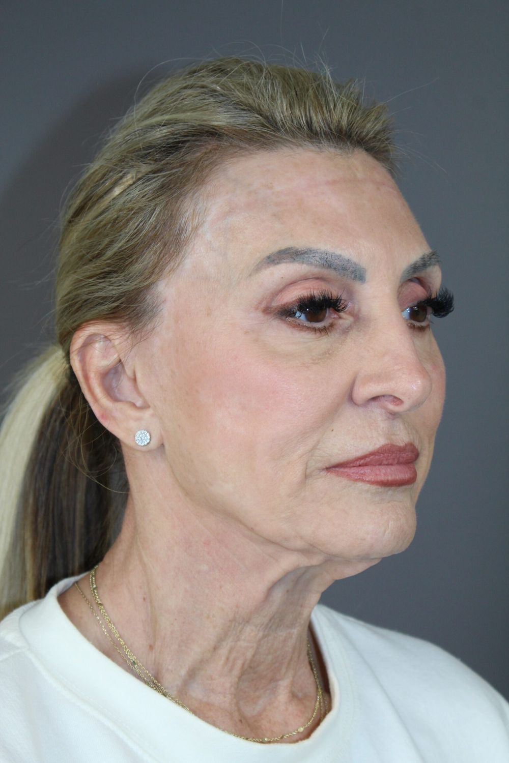 Facial Peels Before & After