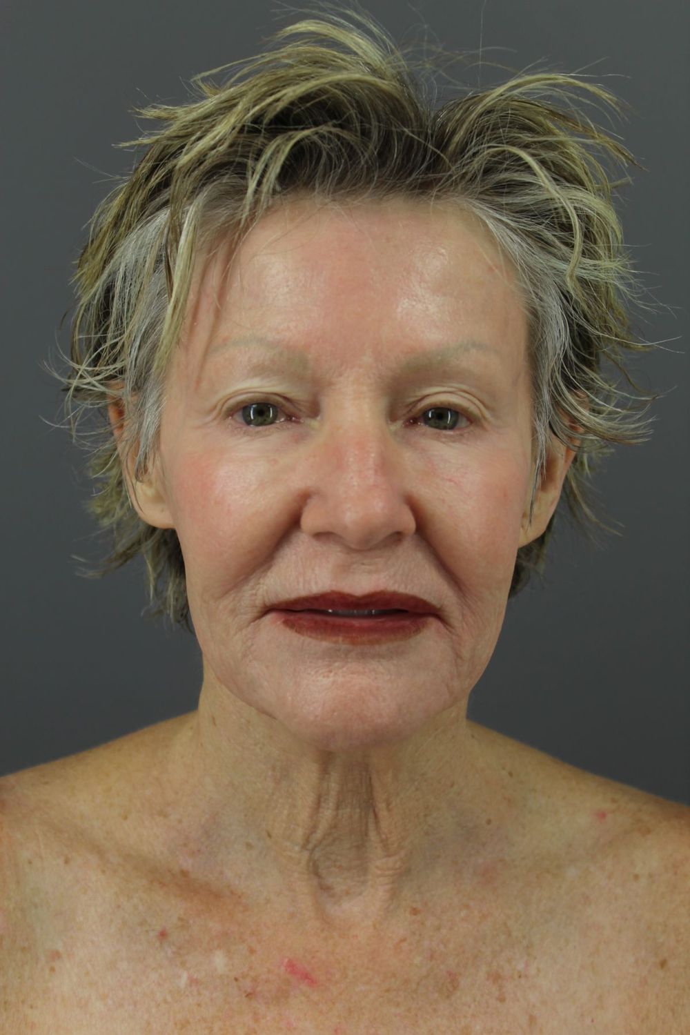 Facial Peels Before & After