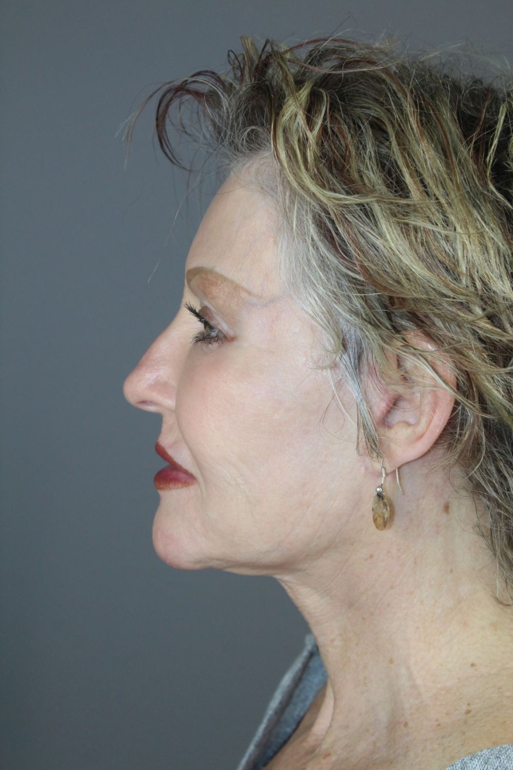 Facial Peels Before & After