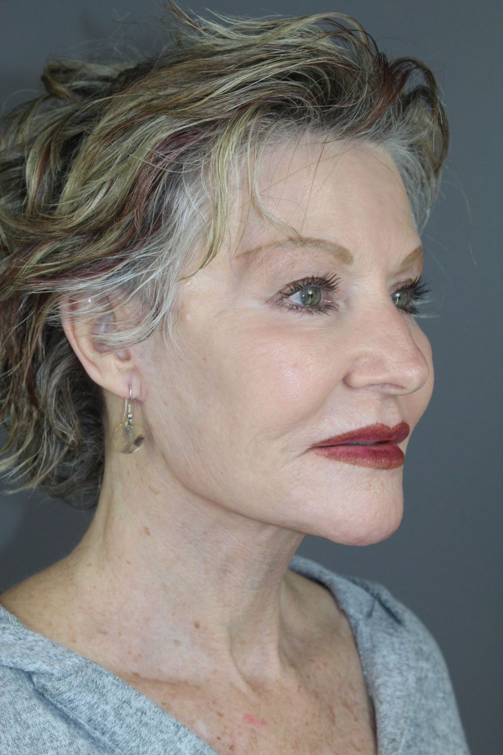 Facial Peels Before & After