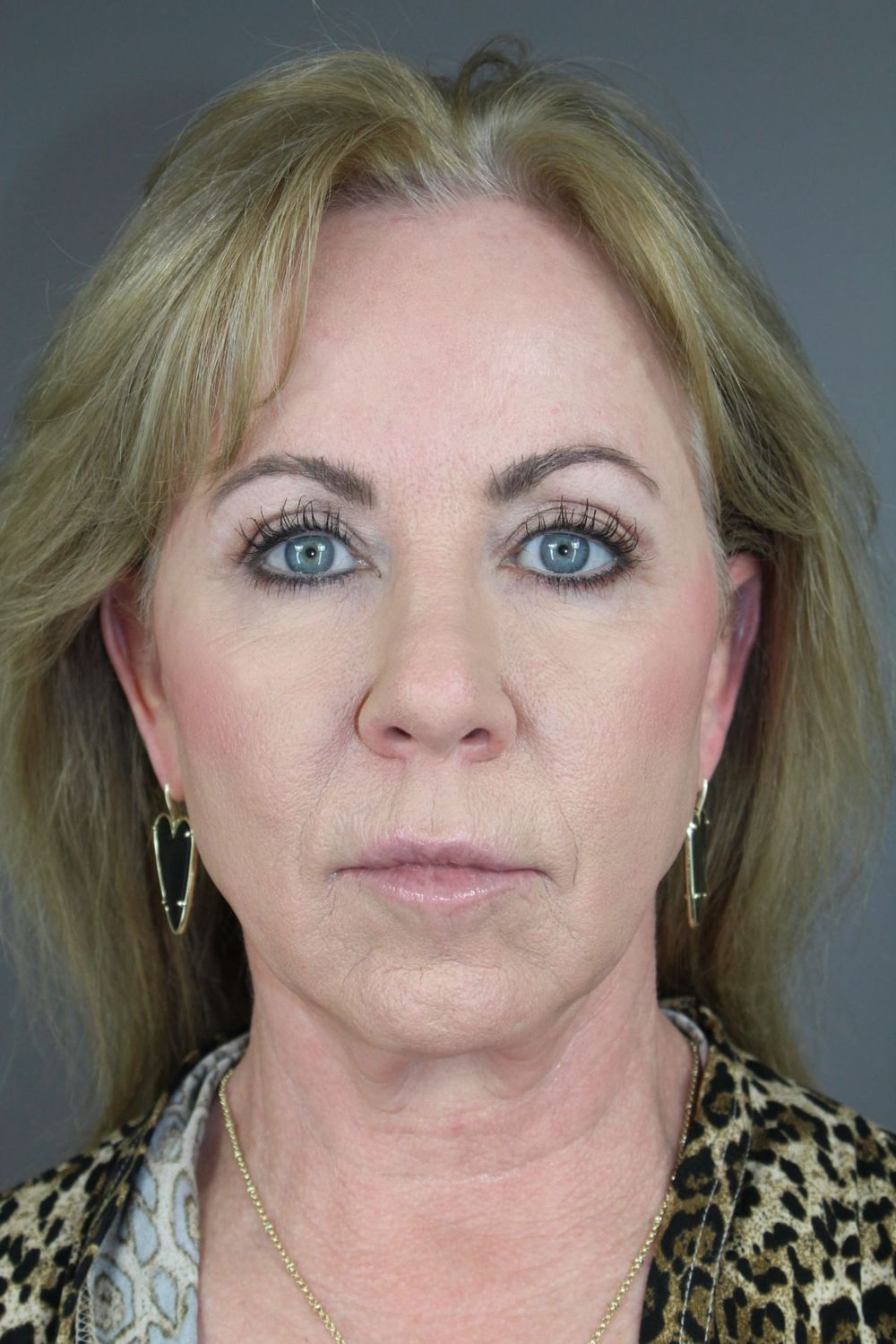 Facial Peels Before & After