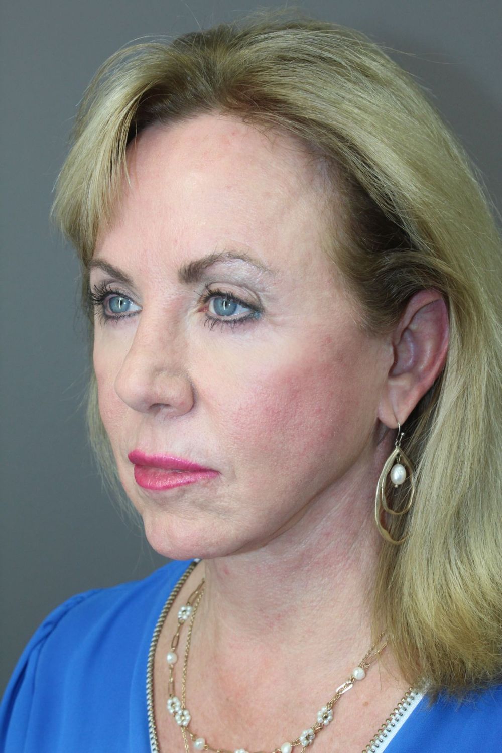 Facial Peels Before & After