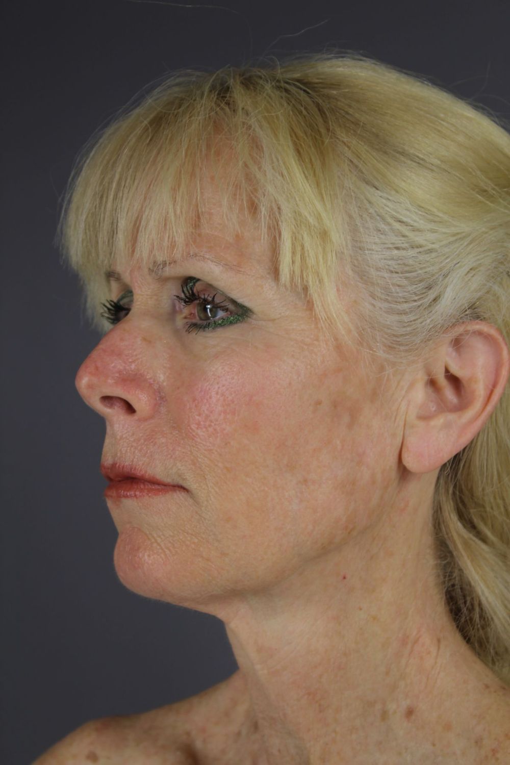 Facial Peels Before & After