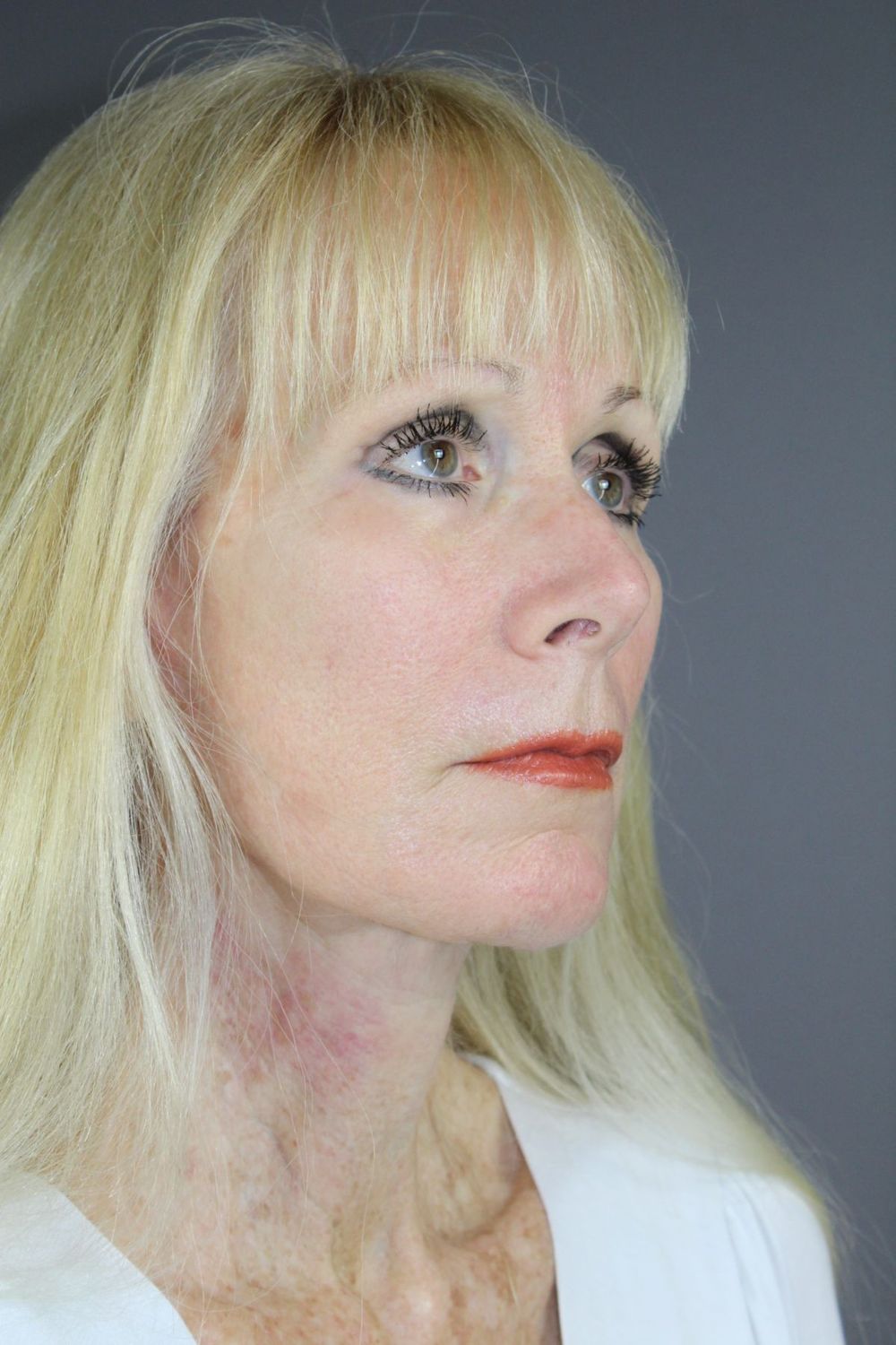 Facial Peels Before & After