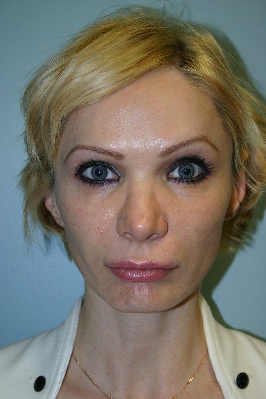 Facial Peels Before & After