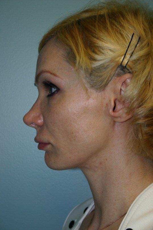Facial Peels Before & After