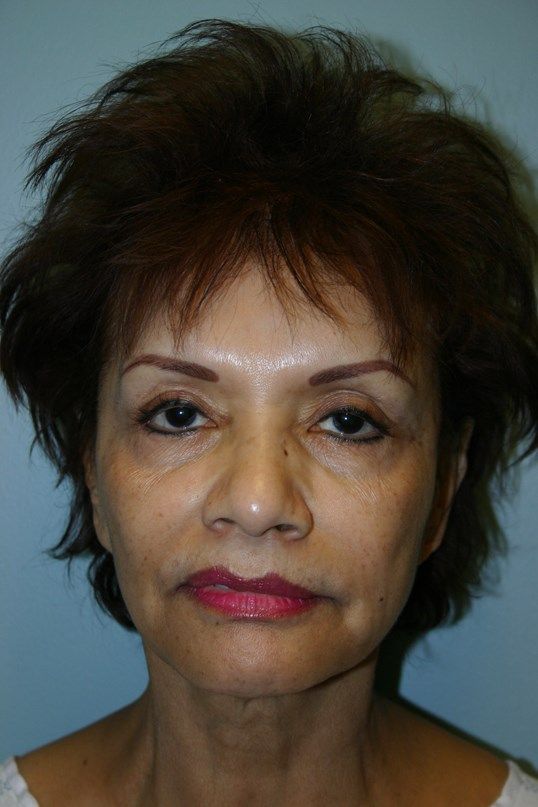 Facial Peels Before & After