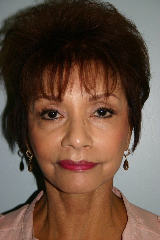 Facial Peels Before & After