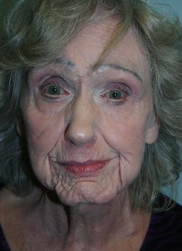 Facial Peels Before & After