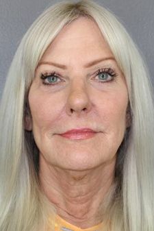 Facial Peels Before & After