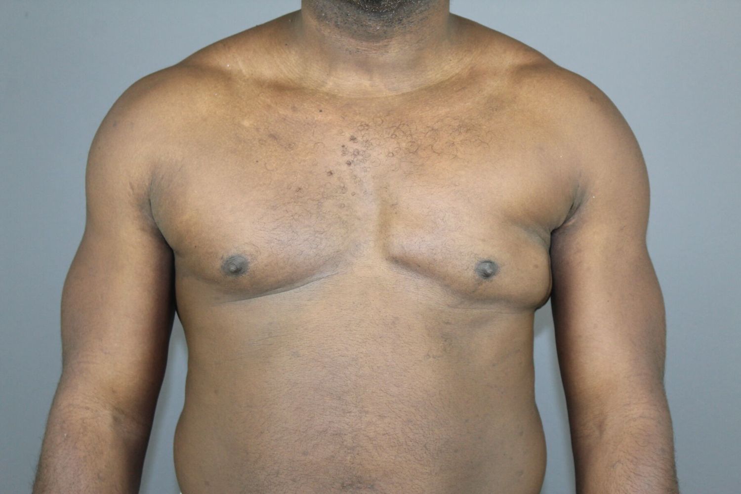 Polands Syndrome Before & After