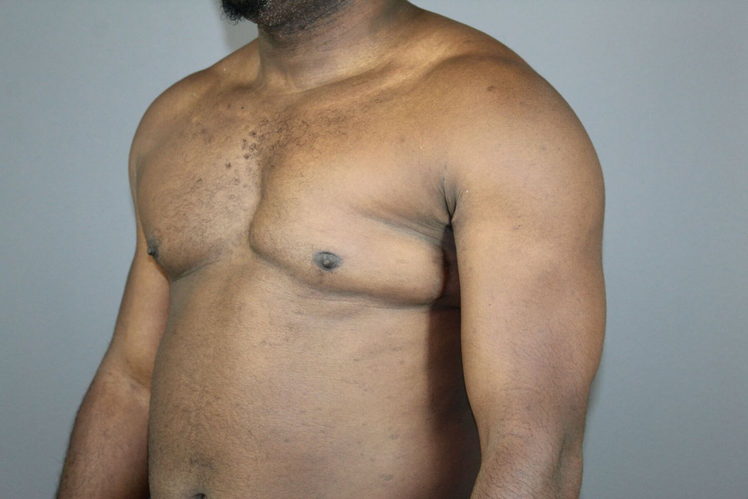 Polands Syndrome Before & After