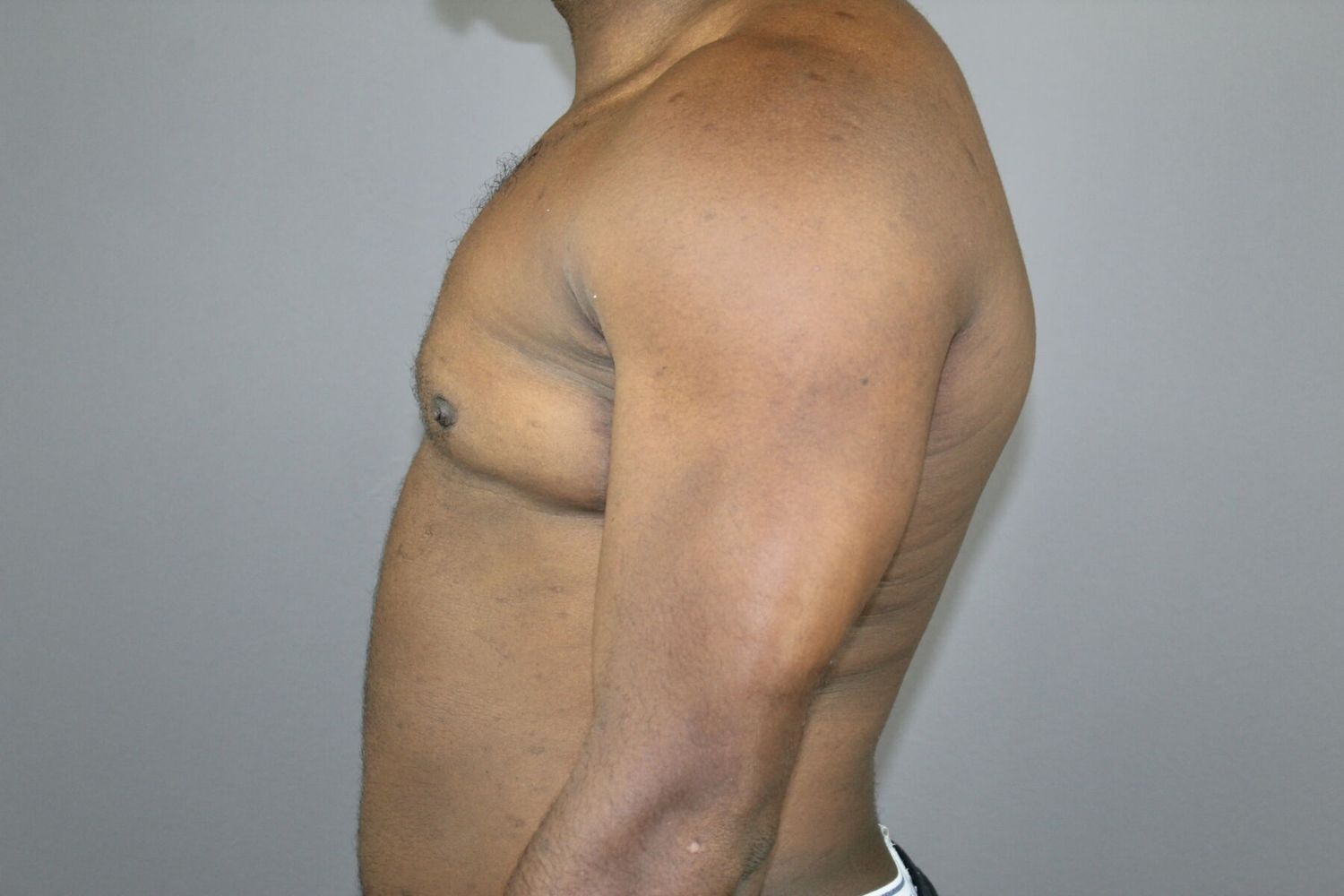 Polands Syndrome Before & After