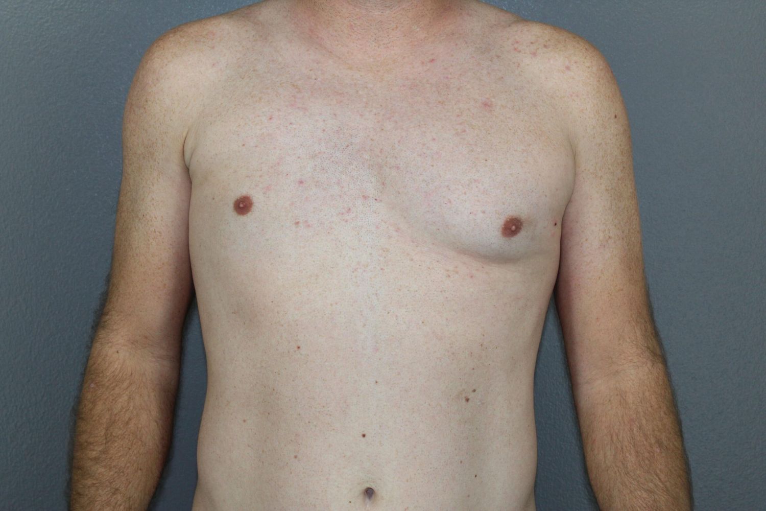 Polands Syndrome Before & After