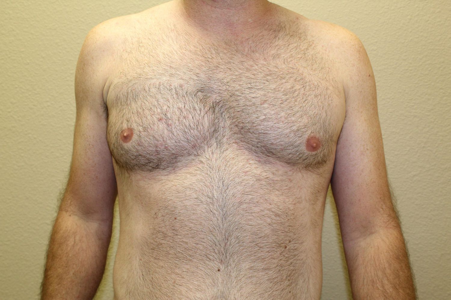 Polands Syndrome Before & After