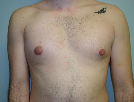 Polands Syndrome Before & After