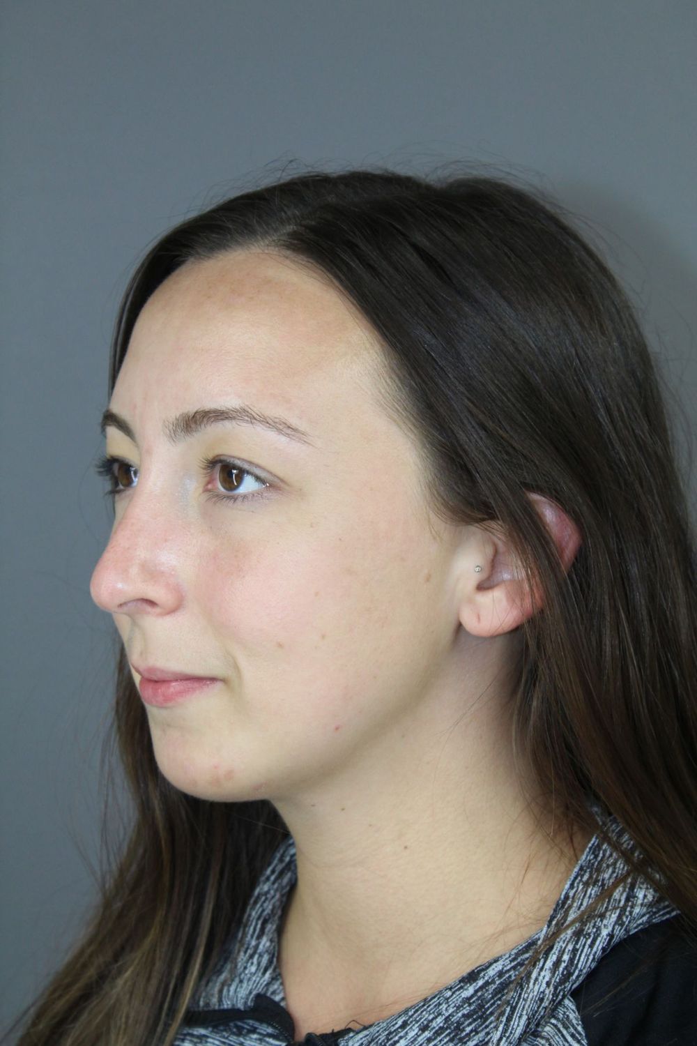 Chin Augmentation Before & After