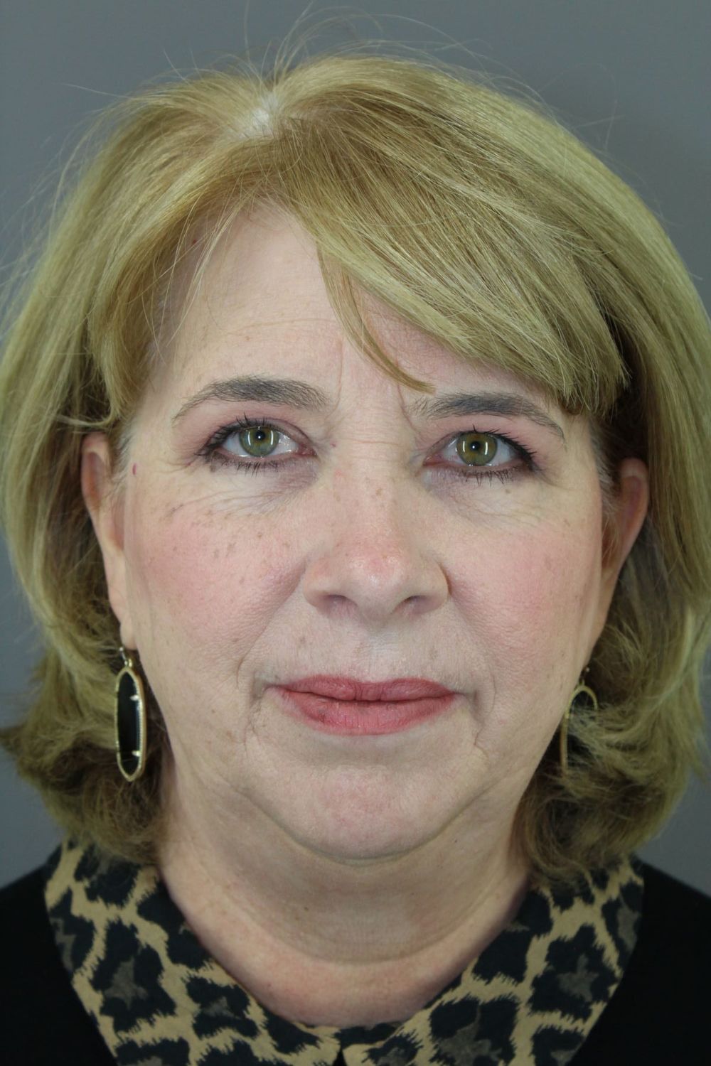 Chin Augmentation Before & After