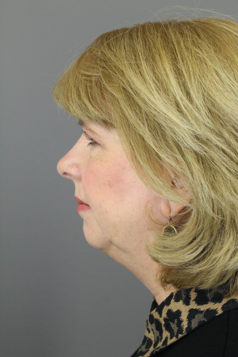 Chin Augmentation Before & After
