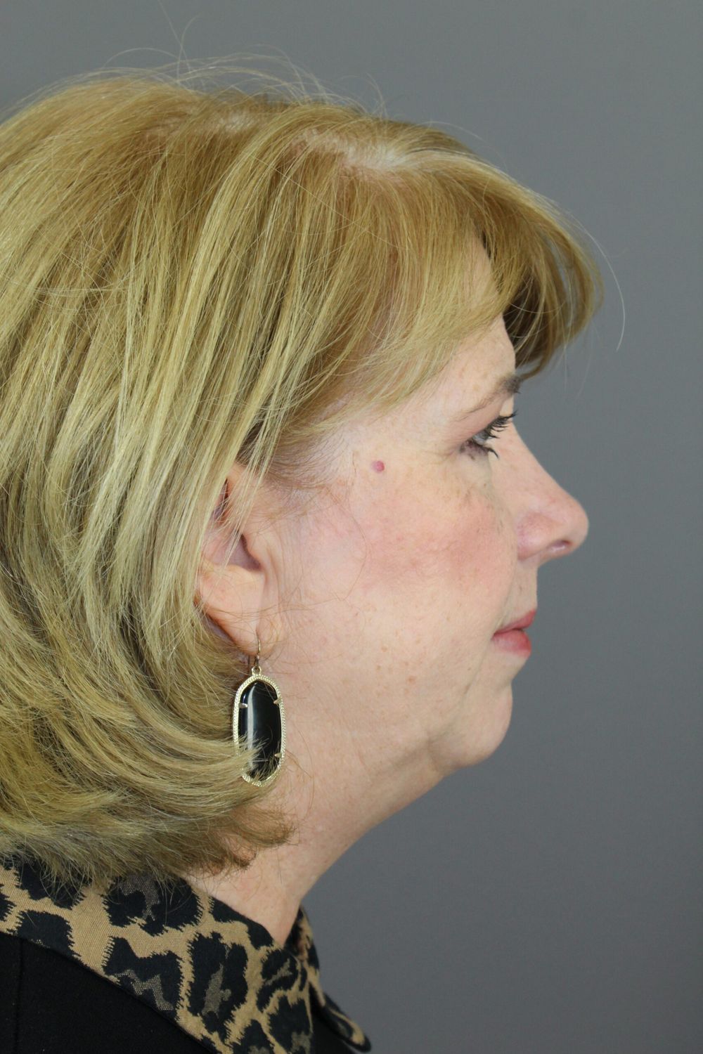 Chin Augmentation Before & After