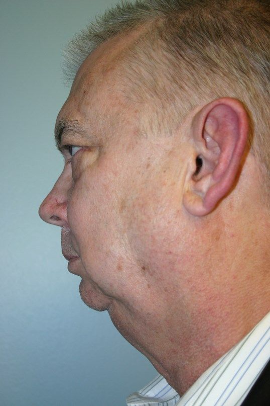 Chin Augmentation Before & After
